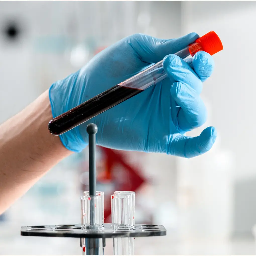 PRP Therapy